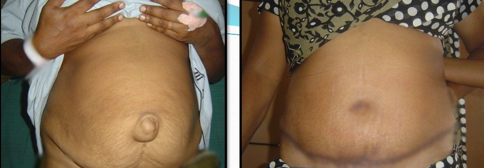 Before and after — Abdominoplasty at SUVA Superspeciality Clinic