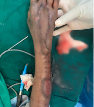 After — Forearm Reconstruction at SUVA Superspeciality Clinic