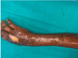 Before — Forearm Reconstruction at SUVA Superspeciality Clinic