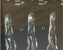 After — Hand & Finger Surgery at SUVA Superspeciality Clinic