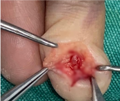 Before — Hand & Finger Surgery at SUVA Superspeciality Clinic