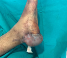 After — Heel & Ankle Reconstruction at SUVA Superspeciality Clinic