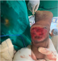 Before — Heel & Ankle Reconstruction at SUVA Superspeciality Clinic
