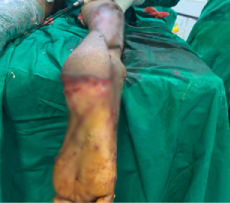 After — lower limb soft tissue reconstruction with flap cover at SUVA Superspeciality Clinic