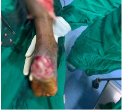 Before — lower limb soft tissue reconstruction with flap cover at SUVA Superspeciality Clinic
