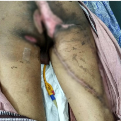 After — wound reconstruction with flap cover at SUVA Superspeciality Clinic